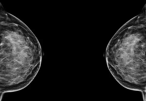 Ray Digital Mammogram Mammography Breast View Diagnonsis Breast Cancer Women — 图库照片