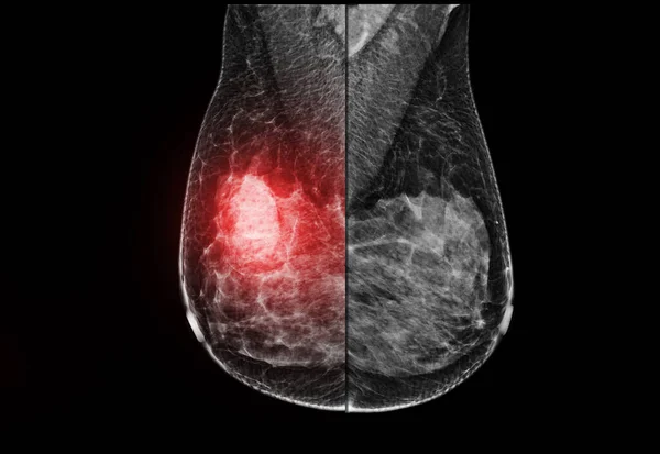 Ray Digital Mammogram Mammography Breast Mlo View Diagnonsis Breast Cancer — Φωτογραφία Αρχείου