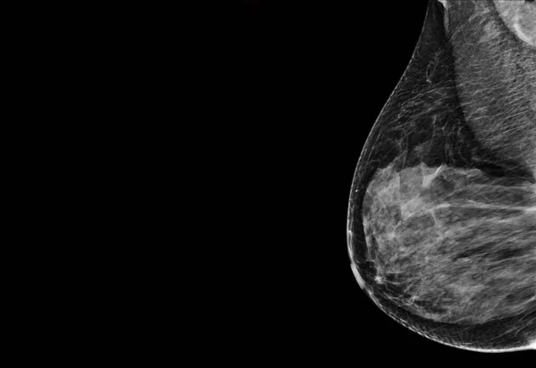 Ray Digital Mammogram Mammography Breast Mlo View Diagnonsis Breast Cancer — 图库照片