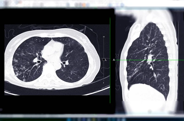 Chest Scan Lung Axial Coronal View Diagnosis Tuberculosis Coronavirus Covid — Stockfoto