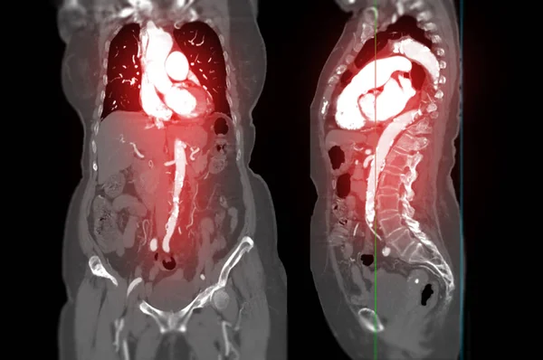 Cta Whole Aorta Showing Image Arteries Whole Body Compare Coronal — ストック写真