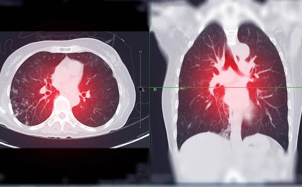 Chest Scan Lung Axial Sagittal View Diagnosis Tuberculosis Coronavirus Covid — ストック写真
