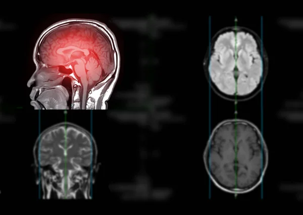 Мрт Осьова Площина Мозку T1W Виявлення Інсультних Захворювань Пухлин Мозку — стокове фото