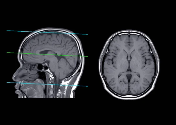 Mri Cérebro Comparar Plano Axial Sagital Para Detectar Doença Acidente — Fotografia de Stock