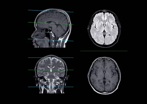 Mri Hersenen Vergelijken Axiale Coronale Sagittale Vlak Voor Het Detecteren — Stockfoto