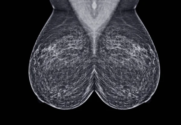 Ray Digitaal Mammogram Mammografie Van Borst Mlo Weergave Voor Ziekte — Stockfoto