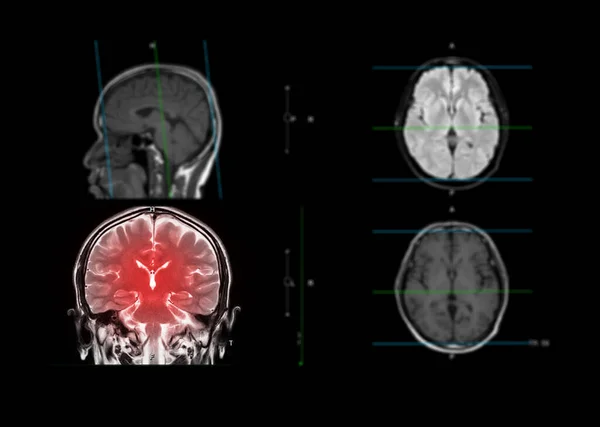 Mri Cérebro Mostrando Plano Coronal Cérebro Para Detectar Doença Acidente — Fotografia de Stock