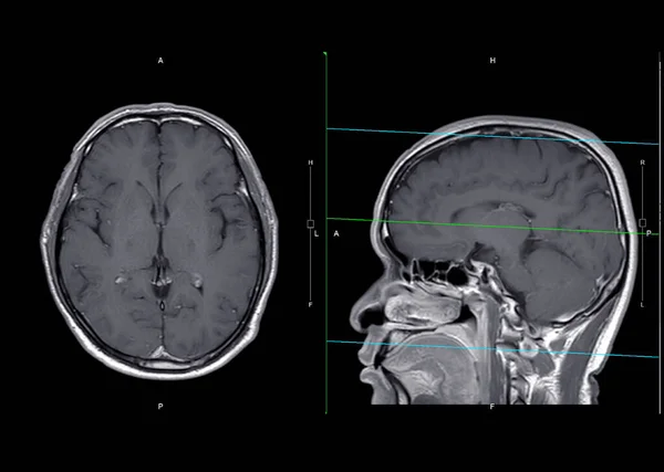 Mri Brain Axial Sagittal Plane Gadolinium Contrast Detect Stroke Disease — 图库照片
