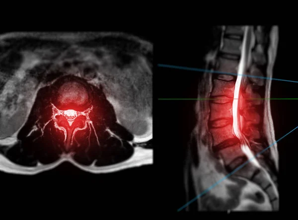 Mri Spine Lumbar Spine Axial T2W View Sagittal Plane Diagnosis — Zdjęcie stockowe