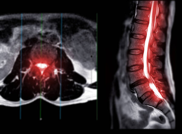MRI L-S spine or lumbar spine Axial T2W view with sagittal plane for diagnosis spinal cord compression.