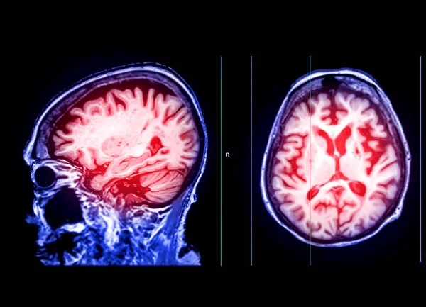 Метод Мрт Мозку Сагітальної Осьової Виявлення Різних Станів Мозку Таких — стокове фото