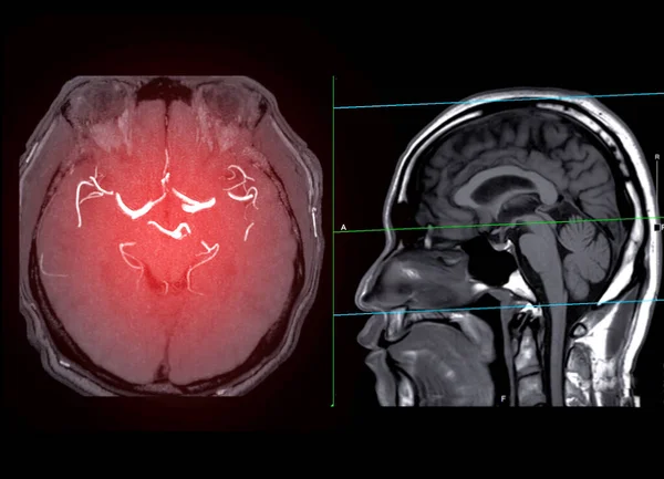 Mra Brain Magnetic Resonance Angiography Brain Axial Mip View Featuring — стокове фото