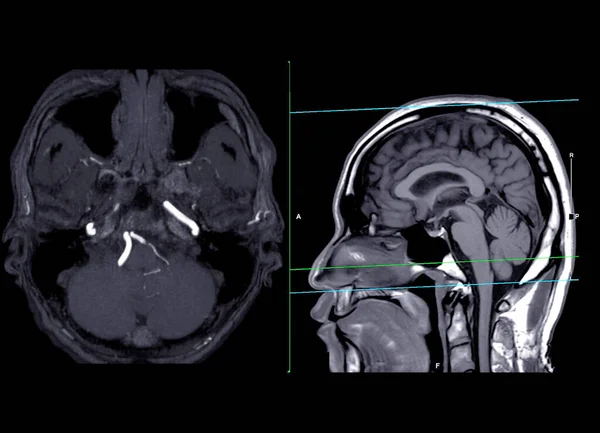 Mra Agyi Vagy Mágneses Rezonancia Angiográfia Agy Axiális Mip Sagittal — Stock Fotó