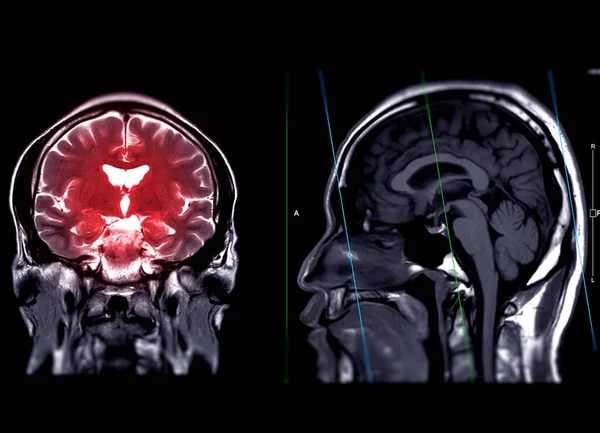 Mri Cérebro Coronal T2W Sagital T1W Técnica Para Detectar Uma — Fotografia de Stock