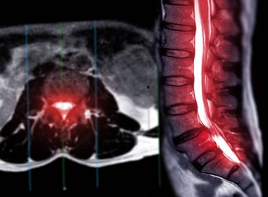 MRI L-S spine or lumbar spine Axial T2W view with sagittal plane for diagnosis spinal cord compression.