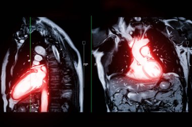 MRI heart or Cardiac MRI ( magnetic resonance imaging ) of heart in Sagittal and Coronal view showing heart beating for detecting heart disease.