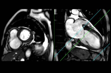 MRI heart or Cardiac MRI ( magnetic resonance imaging ) of heart in short axis and Vertical long axis view showing heart beating sa plane for detecting heart disease.
