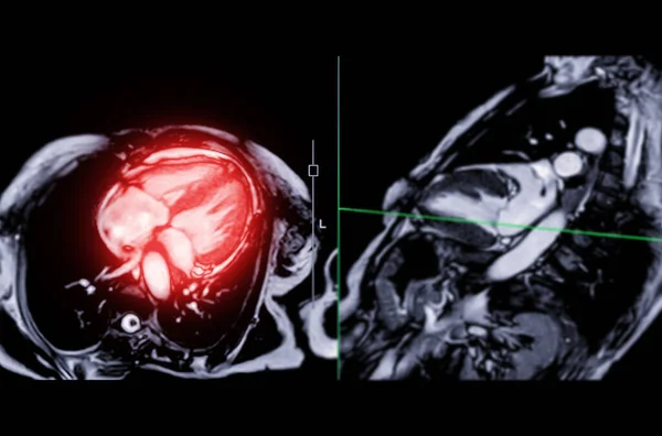 Mri Heart Cardiac Mri Magnetic Resonance Imaging Heart Long Axis — Fotografia de Stock