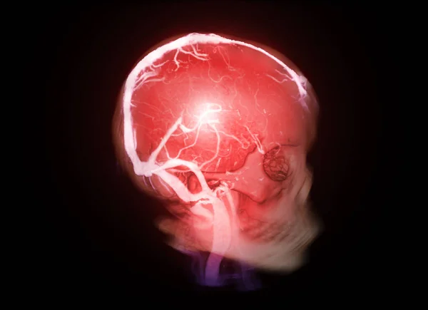 Skull Ctv Brain Showing Dural Venous Sinuses Diagnosis Venous Sinus — Foto Stock