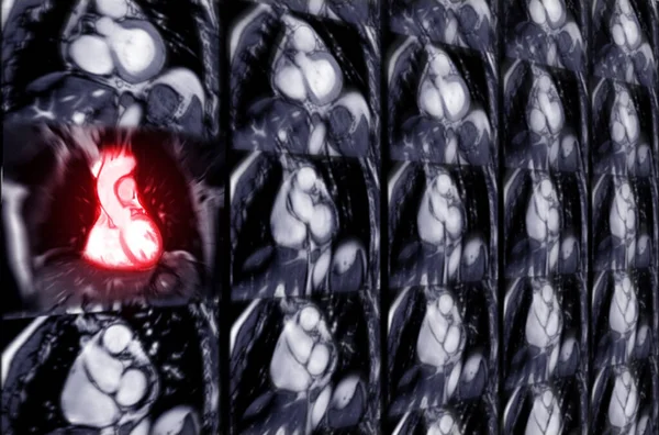 MRI heart or Cardiac MRI ( magnetic resonance imaging ) of heart in coronal view showing heart beating sa plane for detecting heart disease.