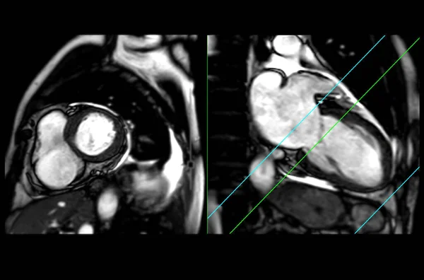 Mri Heart Cardiac Mri Magnetic Resonance Imaging Heart Short Axis — стоковое фото