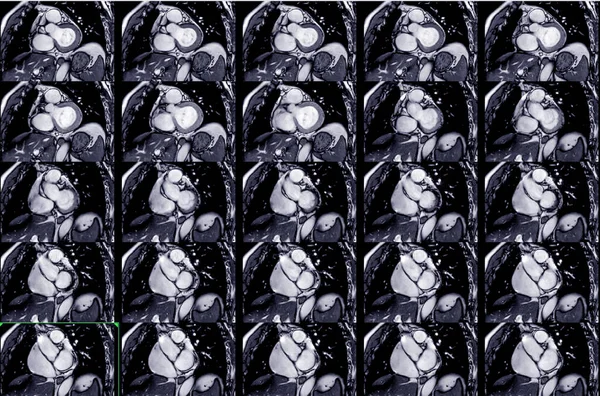 Mri Heart Cardiac Mri Magnetic Resonance Imaging Heart Coronal View — Fotografia de Stock