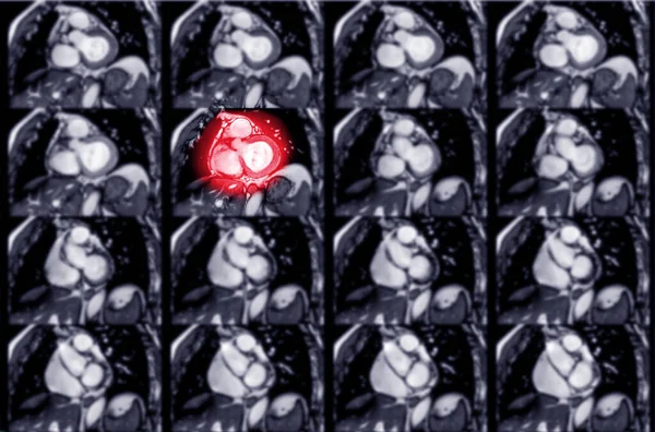 MRI heart or Cardiac MRI ( magnetic resonance imaging ) of heart in coronal view showing heart beating sa plane for detecting heart disease.
