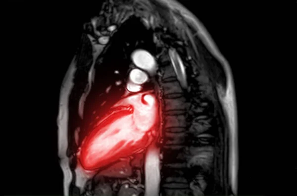Mri Heart Cardiac Mri Magnetic Resonance Imaging Heart Sagittal View —  Fotos de Stock