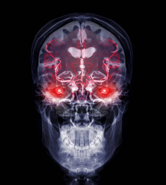 Skull Image Fusion Mri Mra Brain Evaluate Them Stenosis Stroke —  Fotos de Stock