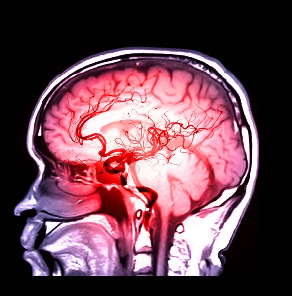 Mra Brain Magnetic Resonance Angiography Cerebral Artery Brain Sagittal View — Fotografia de Stock