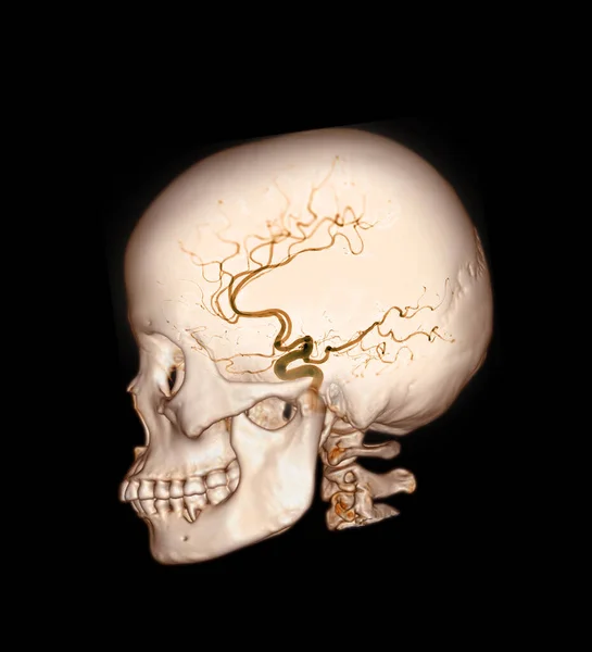Skull Cerebral Artery Medical Imaging Concept — стоковое фото