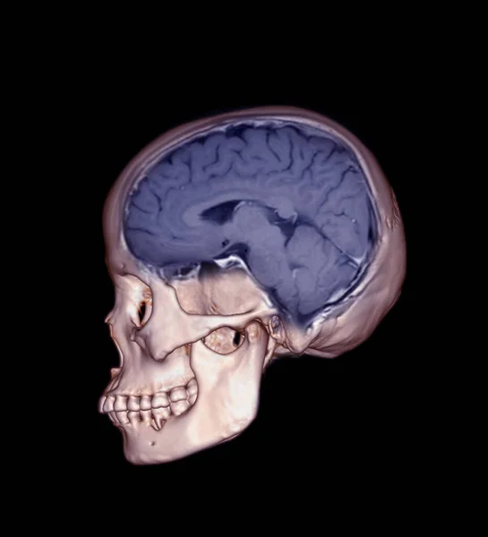 Розріз Черепа Показує Концепцію Медичної Візуалізації Мозку Mri — стокове фото