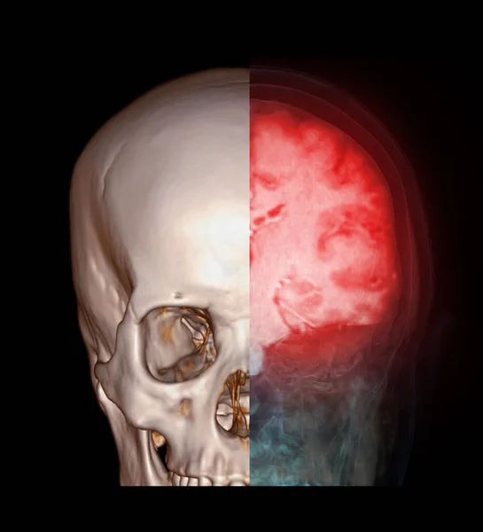 Skull 3D with Mri brain medical imaging concept.