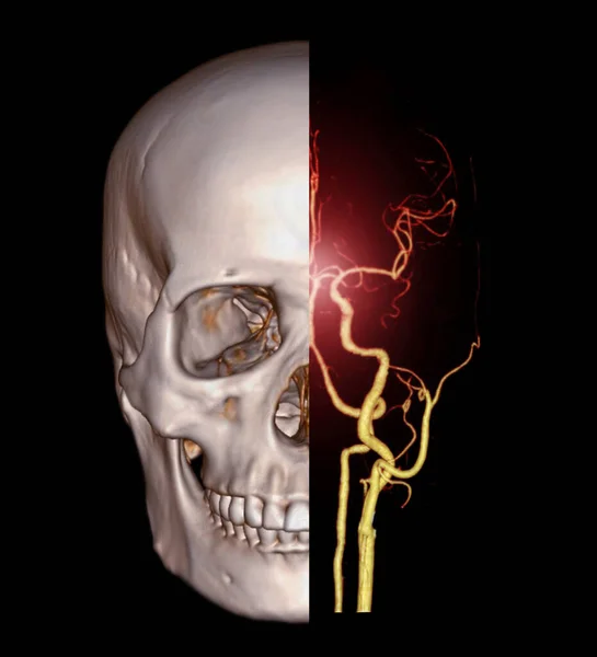 Skull Cerebral Artery Medical Imaging Concept — Foto Stock
