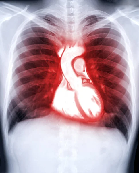 Chest Ray Image Fusion Mri Heart Diagnosis Heart Diseases — Stock Photo, Image