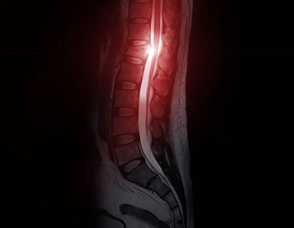 MRI Lumbar spine sagittal T2W Fat suppression.