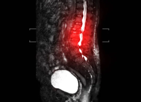 Mri Lumbar Spine Sagittal T2W Fat Suppression — Foto de Stock