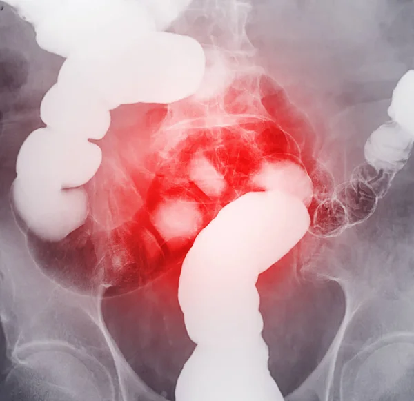 Barium enema or BE is image of large bowel after injection of barium contrast fill into colon under fluoroscopic control isolated on white background for diagnosis colon cancer.