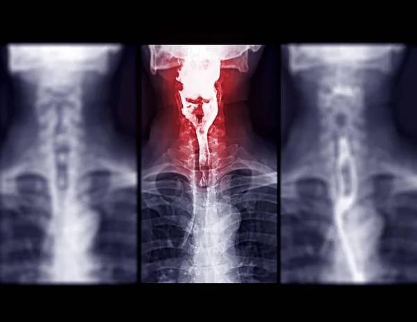 Barium Swallow study test diagnose Barrett\'s GI tract exam GERD ulcers series difficulty pharynx procedure UGI throat bowel therapy by fluoroscopy devices.