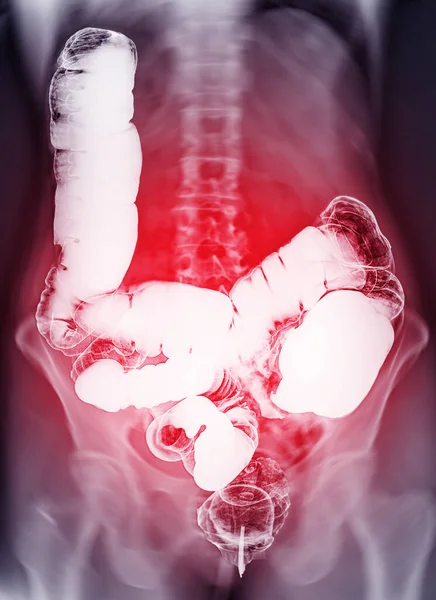 Barium enema or BE is image of large bowel after injection of barium contrast fill into colon under fluoroscopic control isolated on white background for diagnosis colon cancer.