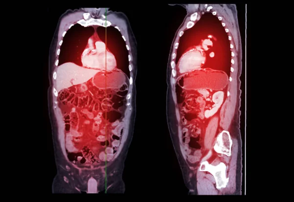 CT SCAN of Chest and Abdomen Coronal and sagittal view with injection contrast media for diagnonsis chest and abdomen disease.