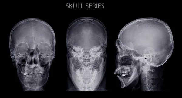 Collection of  Skull x-ray image name is skull series isolated on Black Background.