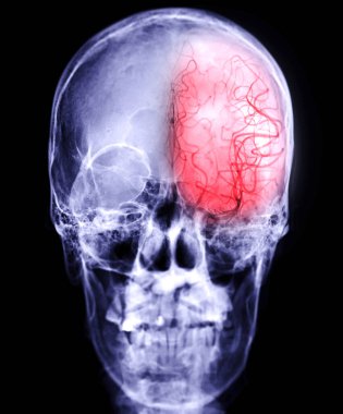 Cerebral angiography  image from Fluoroscopy with skull of human  showing cerebral artery.