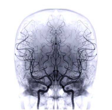 Cerebral angiography  image from Fluoroscopy in intervention radiology  showing cerebral artery.