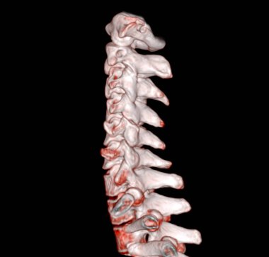 CT SCAN of Cervical Spine ( C-spine ) patient trauma case 3D rendering image . 