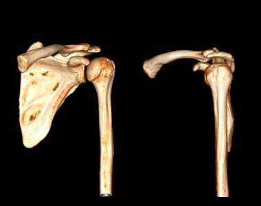 Computed Tomography Volume Rendering examination of the Shoulder 3D rendering in patient fracture shoulder joint.