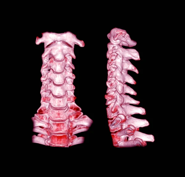 CT SCAN of Cervical Spine ( C-spine ) patient trauma case 3D rendering image .