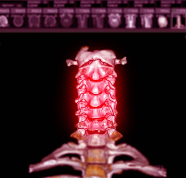 CT SCAN of Cervical Spine ( C-spine ) patient trauma case 3D rendering image .