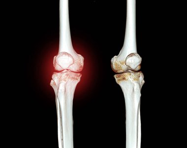 Tomografi diz kırığı teşhisi için siyah arkaplanda izole edilmiş 3D görüntüleme.