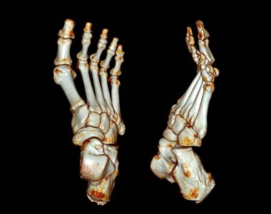 Foot 'un hesaplanmış tomografisi, 3D ses ayarı taraması (CT VR Foot). 3B görüntüleme.